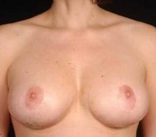 Aesthetic Breast Revision Before & After Gallery - Patient 101809 - Image 2
