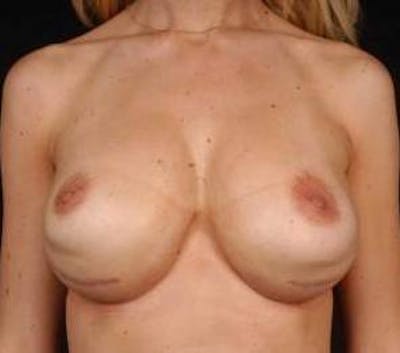 Aesthetic Breast Revision Before & After Gallery - Patient 301576 - Image 1