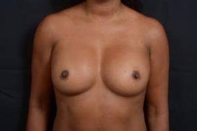 Aesthetic Breast Revision Before & After Gallery - Patient 233012 - Image 1