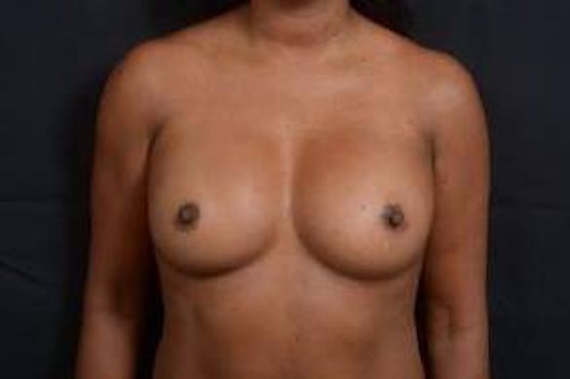 Aesthetic Breast Revision Before & After Gallery - Patient 233012 - Image 1