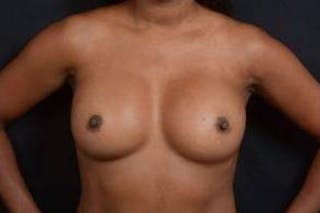 Aesthetic Breast Revision Before & After Gallery - Patient 233012 - Image 2
