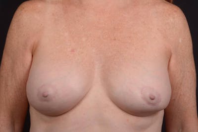 Aesthetic Breast Revision Before & After Gallery - Patient 279658 - Image 1