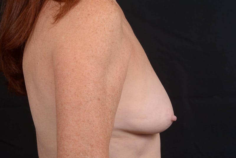 Aesthetic Breast Revision Before & After Gallery - Patient 279658 - Image 5