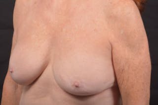 Aesthetic Breast Revision Before & After Gallery - Patient 279658 - Image 8