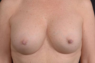Aesthetic Breast Revision Before & After Gallery - Patient 831051 - Image 1