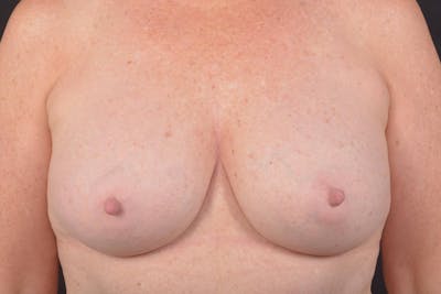 Aesthetic Breast Revision Before & After Gallery - Patient 831051 - Image 2