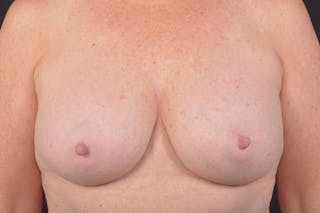 Aesthetic Breast Revision Before & After Gallery - Patient 831051 - Image 2