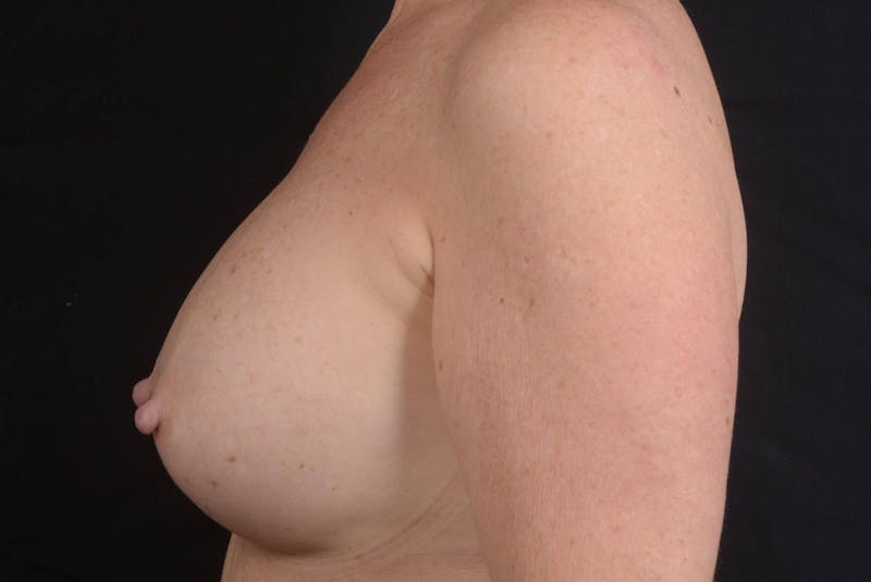 Aesthetic Breast Revision Before & After Gallery - Patient 831051 - Image 3