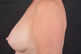 Aesthetic Breast Revision Before & After Gallery - Patient 831051 - Image 4