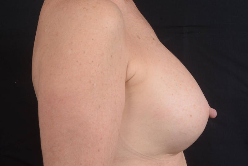 Aesthetic Breast Revision Before & After Gallery - Patient 831051 - Image 5
