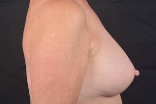 Aesthetic Breast Revision Before & After Gallery - Patient 831051 - Image 6