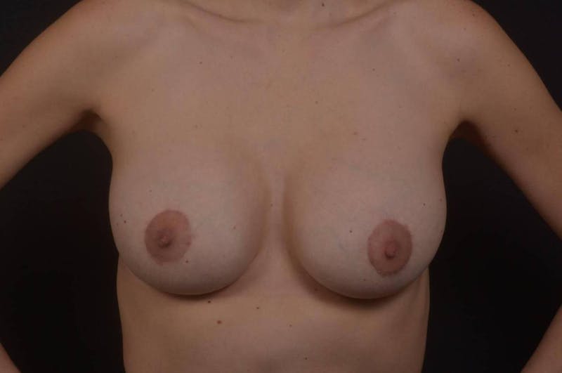 Aesthetic Breast Revision Before & After Gallery - Patient 320557 - Image 2