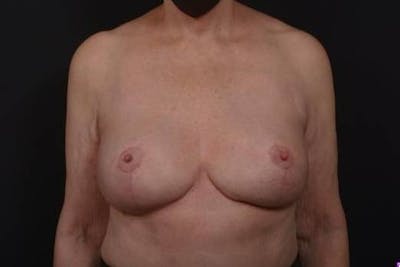 Aesthetic Breast Revision Before & After Gallery - Patient 146385 - Image 2