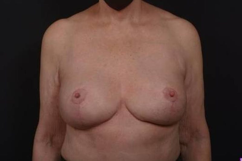 Aesthetic Breast Revision Before & After Gallery - Patient 146385 - Image 2