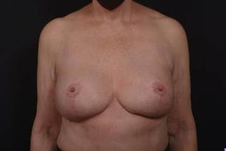 Aesthetic Breast Revision Before & After Gallery - Patient 146385 - Image 2