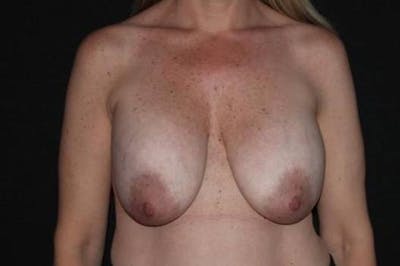 Breast Implant Removal and Mastopexy Before & After Gallery - Patient 946427 - Image 1