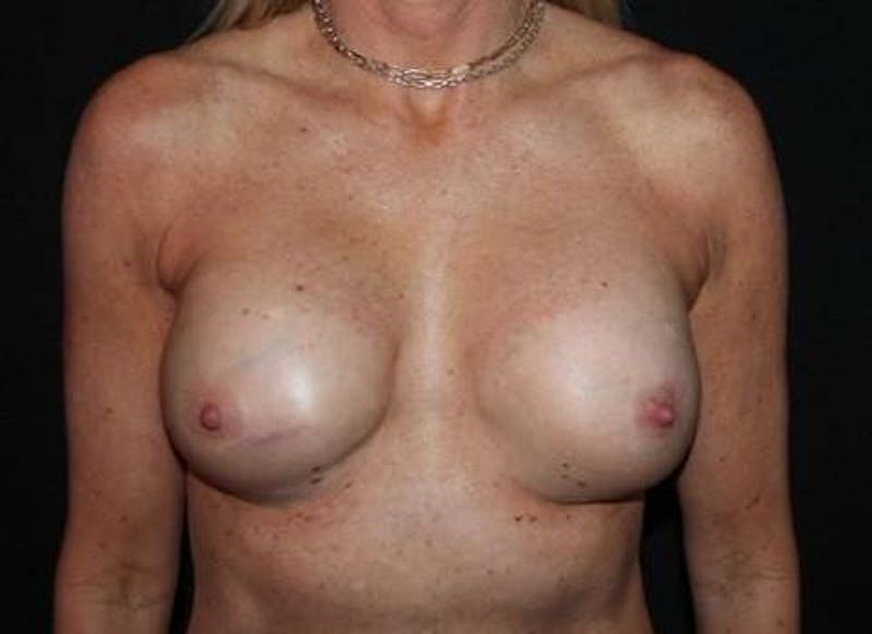 Aesthetic Breast Revision Before & After Gallery - Patient 134115 - Image 1