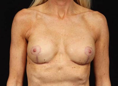 Aesthetic Breast Revision Before & After Gallery - Patient 134115 - Image 2