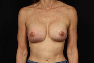 Aesthetic Breast Revision Before & After Gallery - Patient 226441 - Image 2