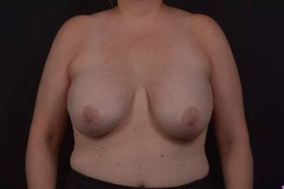 Aesthetic Breast Revision Before & After Gallery - Patient 162126 - Image 1
