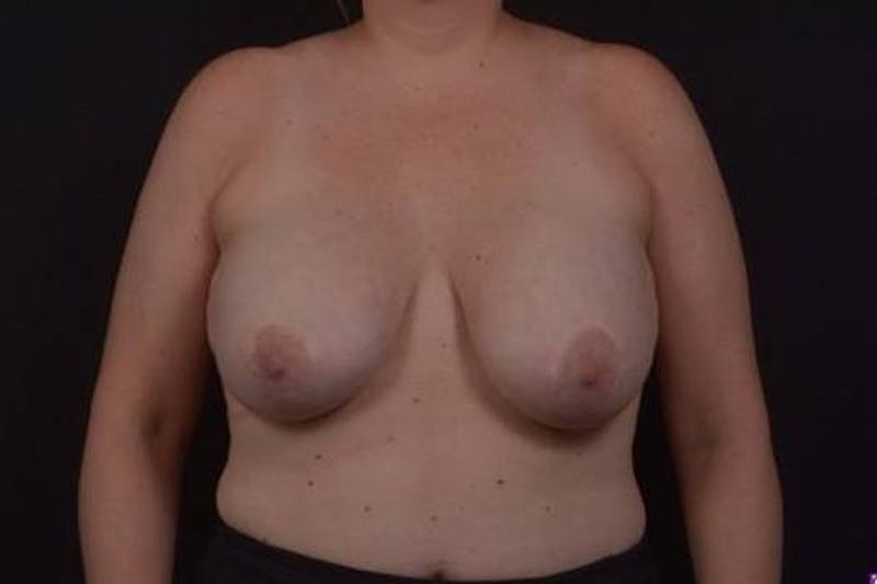 Aesthetic Breast Revision Before & After Gallery - Patient 162126 - Image 1