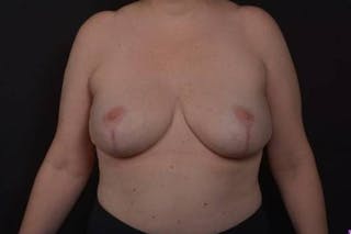 Aesthetic Breast Revision Before & After Gallery - Patient 162126 - Image 2