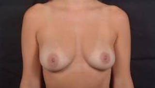 Aesthetic Breast Revision Before & After Gallery - Patient 343067 - Image 2