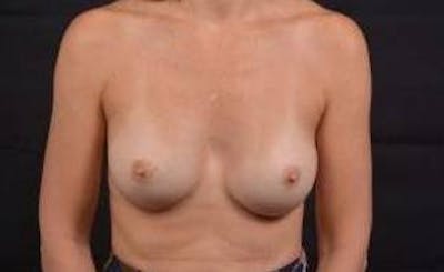 Aesthetic Breast Revision Before & After Gallery - Patient 179852 - Image 1