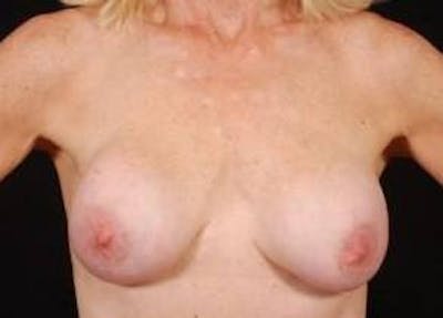 Aesthetic Breast Revision Before & After Gallery - Patient 164599 - Image 1