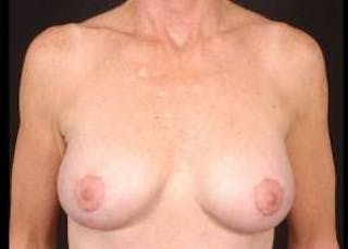 Aesthetic Breast Revision Before & After Gallery - Patient 164599 - Image 2