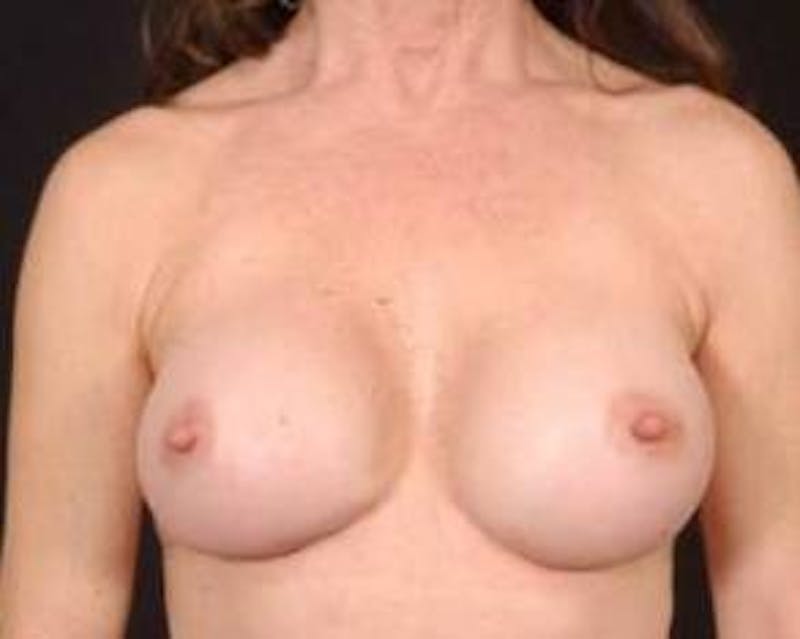 Aesthetic Breast Revision Before & After Gallery - Patient 262874 - Image 2
