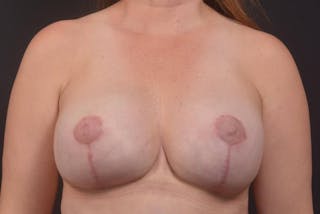 Aesthetic Breast Revision Before & After Gallery - Patient 187566 - Image 2