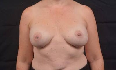 Aesthetic Breast Revision Before & After Gallery - Patient 241446 - Image 1