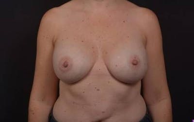 Aesthetic Breast Revision Before & After Gallery - Patient 241446 - Image 2