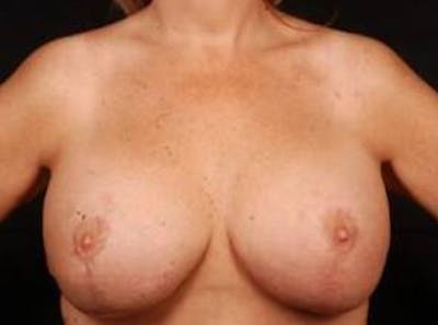 Aesthetic Breast Revision Before & After Gallery - Patient 425515 - Image 2