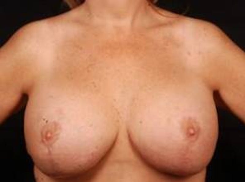 Aesthetic Breast Revision Before & After Gallery - Patient 425515 - Image 2