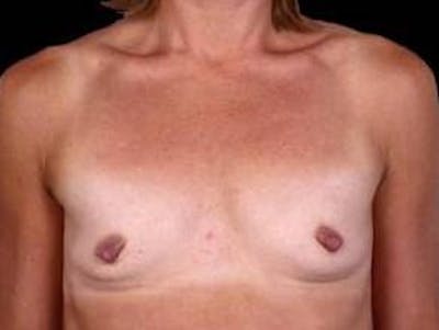 Breast Augmentation 410 Before & After Gallery - Patient 398706 - Image 1