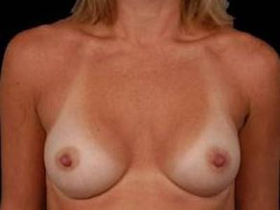 Breast Augmentation 410 Before & After Gallery - Patient 398706 - Image 2