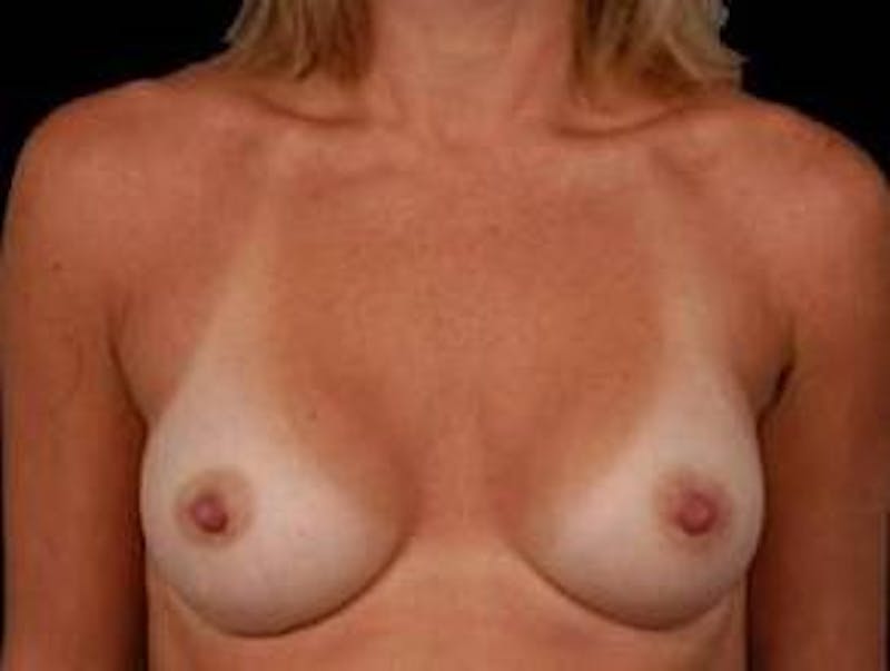 Breast Augmentation 410 Before & After Gallery - Patient 398706 - Image 2