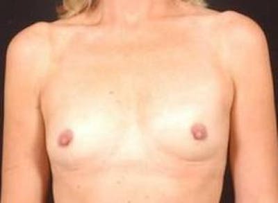 Breast Augmentation 410 Before & After Gallery - Patient 864956 - Image 1