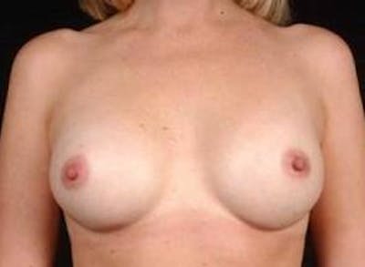 Breast Augmentation 410 Before & After Gallery - Patient 864956 - Image 2