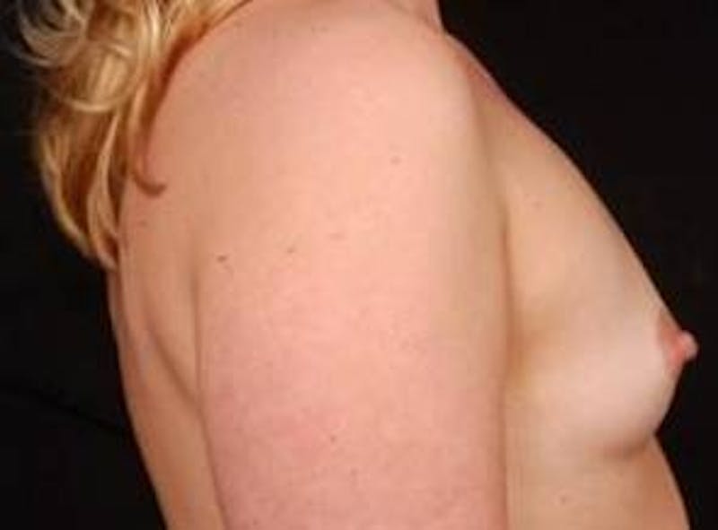 Breast Augmentation 410 Before & After Gallery - Patient 291770 - Image 5