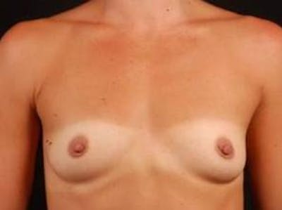 Breast Augmentation 410 Before & After Gallery - Patient 151017 - Image 1
