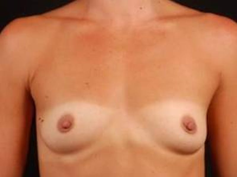 Breast Augmentation 410 Before & After Gallery - Patient 151017 - Image 1