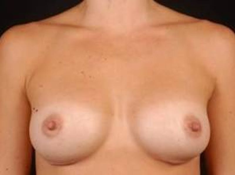 Breast Augmentation 410 Before & After Gallery - Patient 151017 - Image 2