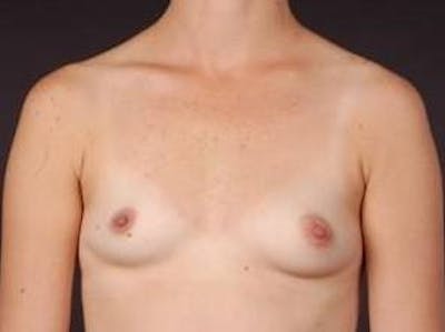 Breast Augmentation 410 Before & After Gallery - Patient 268708 - Image 1