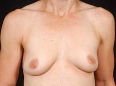 Breast Augmentation 410 Before & After Gallery - Patient 342084 - Image 1