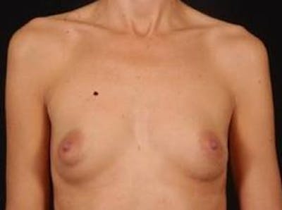 Breast Augmentation 410 Before & After Gallery - Patient 300083 - Image 1