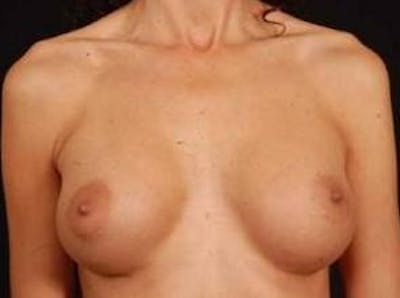Breast Augmentation 410 Before & After Gallery - Patient 300083 - Image 2