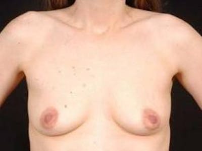 Breast Augmentation 410 Before & After Gallery - Patient 378964 - Image 1